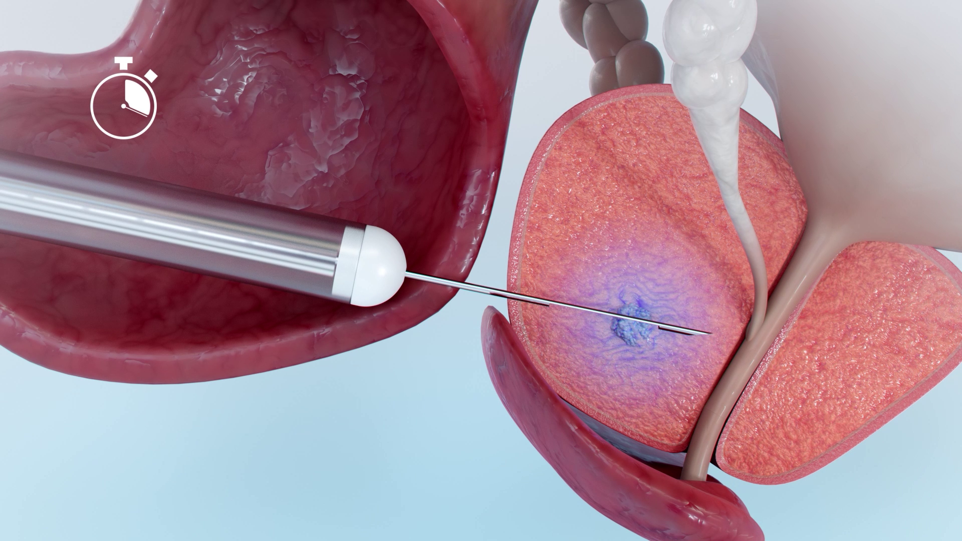 Hitting Target prostate biopsy